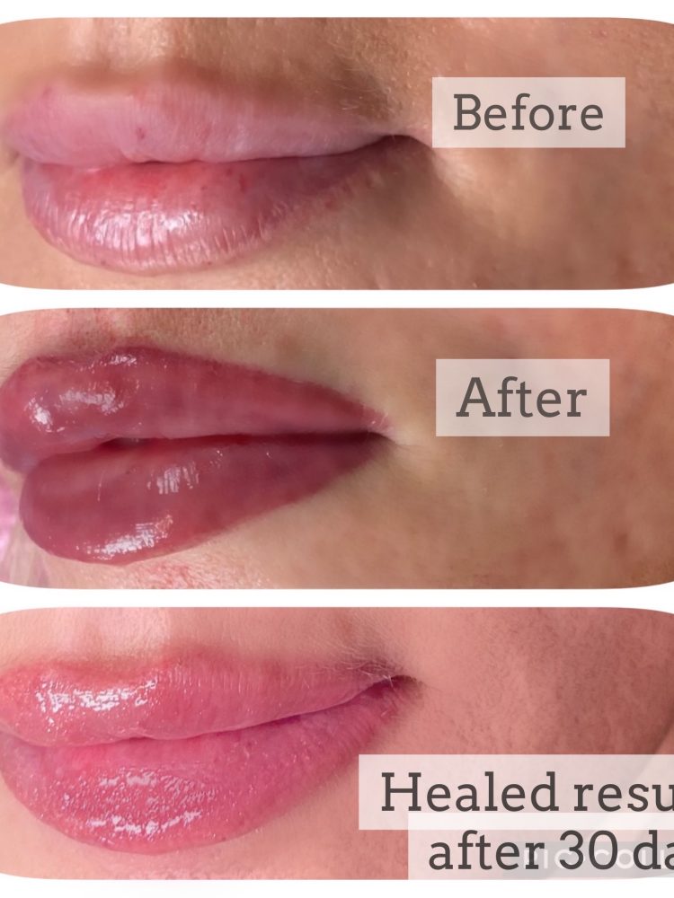 before and after lip blush procedure